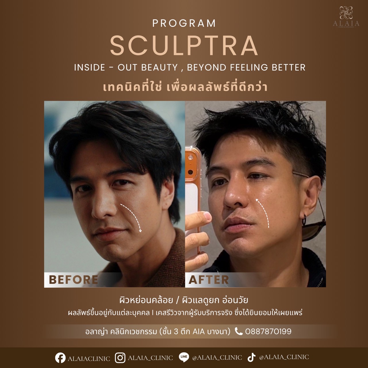 Sculptra Real Result 1