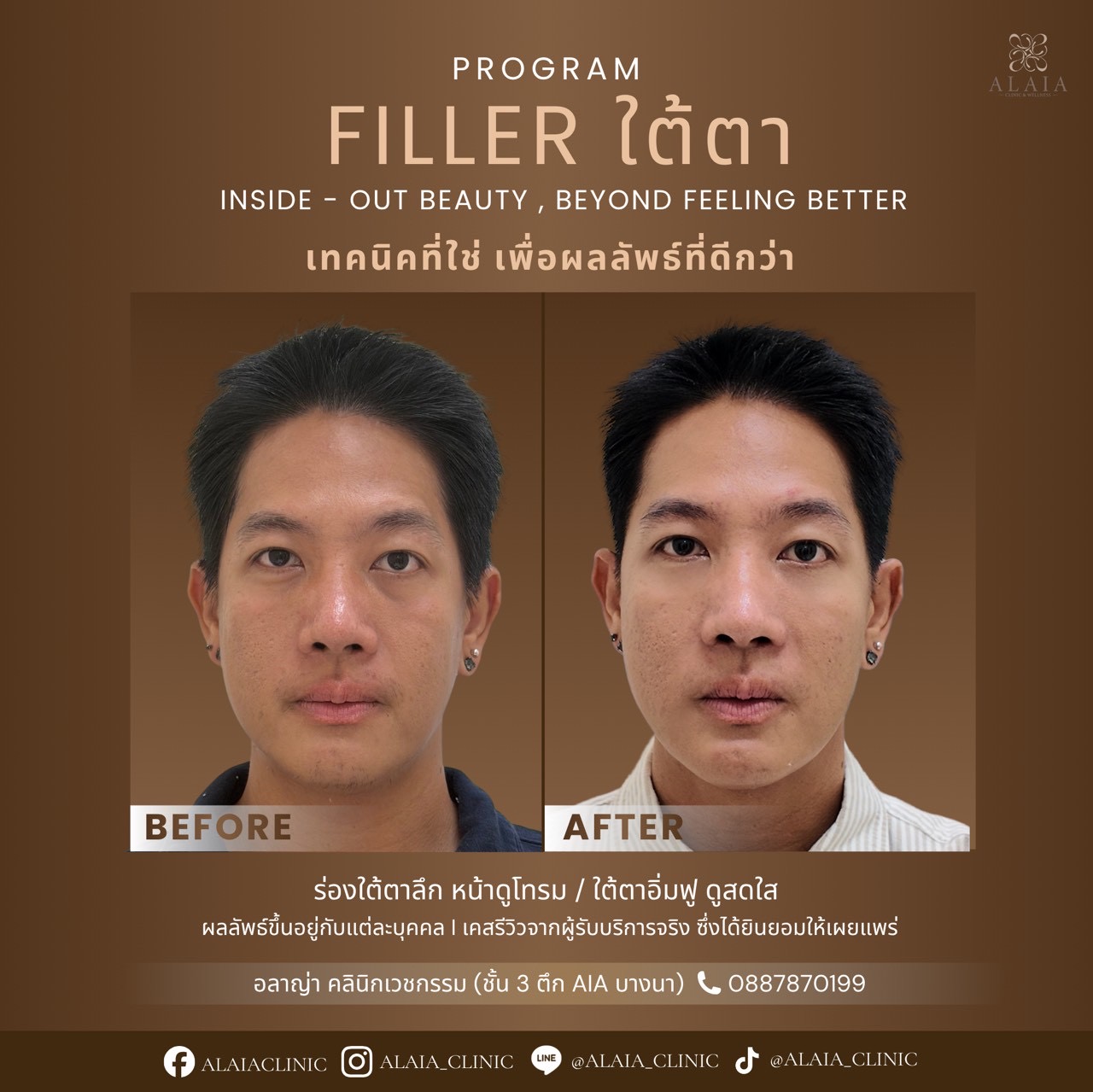 Filler Real Result 4