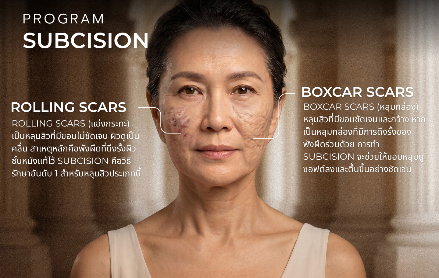 โปรแกรม Subcision เหมาะกับใคร